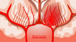 Brain tumor ตัวอย่างภาพบน YouTube template