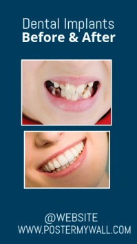 dental implants before after photo Digitale Vertoning (9:16) template