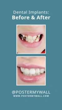 Dental Implants Before After Photo Template Instagram Story