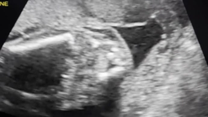 Medical ultrasound YouTube-miniature template