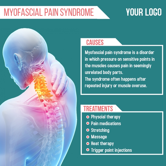 Myofascial Pain Syndrome Template Postermywall