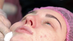 pimple treatment video YouTube-miniature template