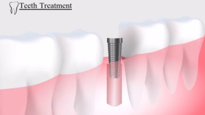 White Teeth treatment YouTube-miniature Template