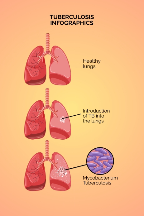 Tuberculosis Abstract Tuberculosis Infographics Poster Template | PosterMyWall